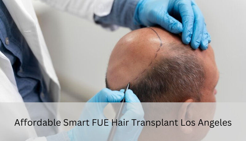 smart fue hair transplant Los Angeles