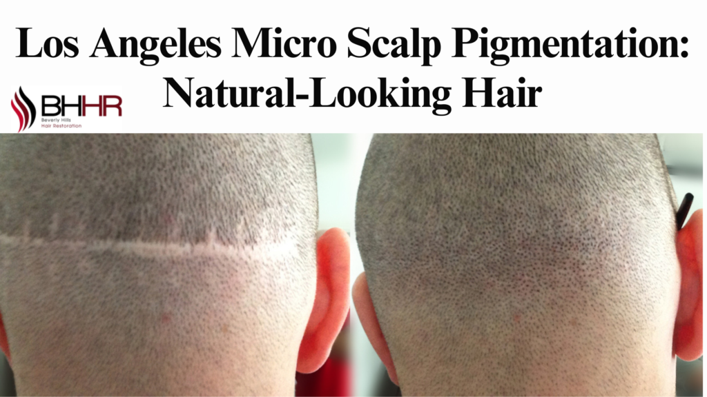 scalp micropigmentation los angeles